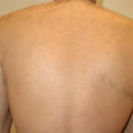 Full Back after laser hair removal