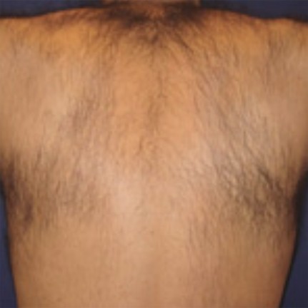 Full Back before laser hair removal