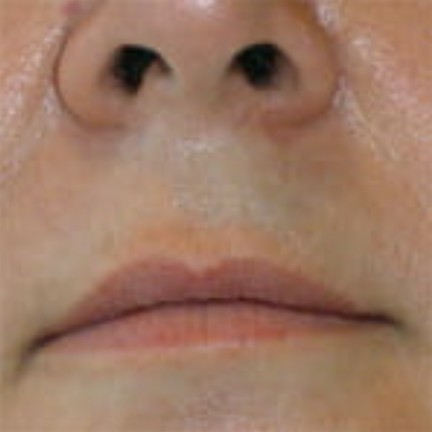 Upper Lip after laser hair removal