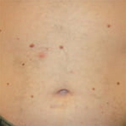 Stomach after laser hair removal
