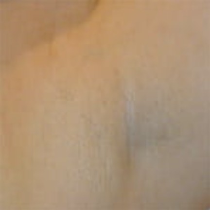 Underarm after laser hair removal