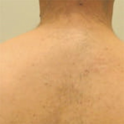 Upper Back after laser hair removal