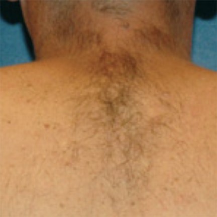 Upper Back before laser hair removal